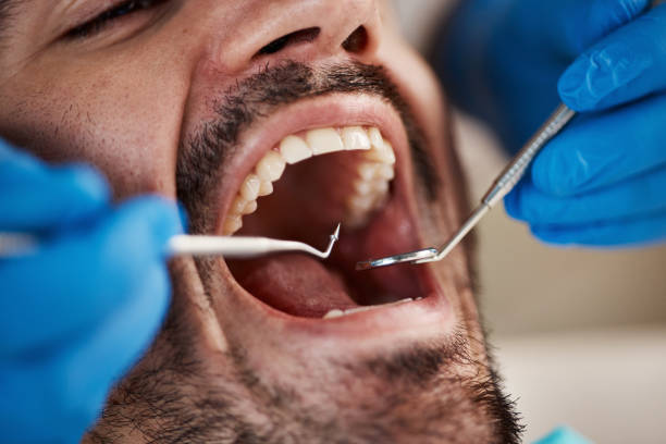 Emergency Dental Filling Replacement in KY